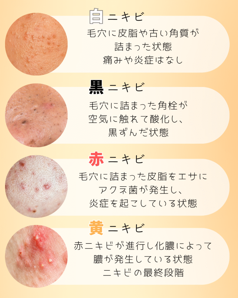 【画像あり】ニキビの種類をわかりやすく解説
