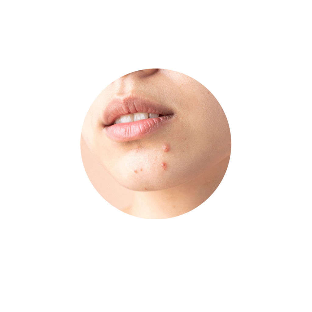 口周り・顎のニキビ
