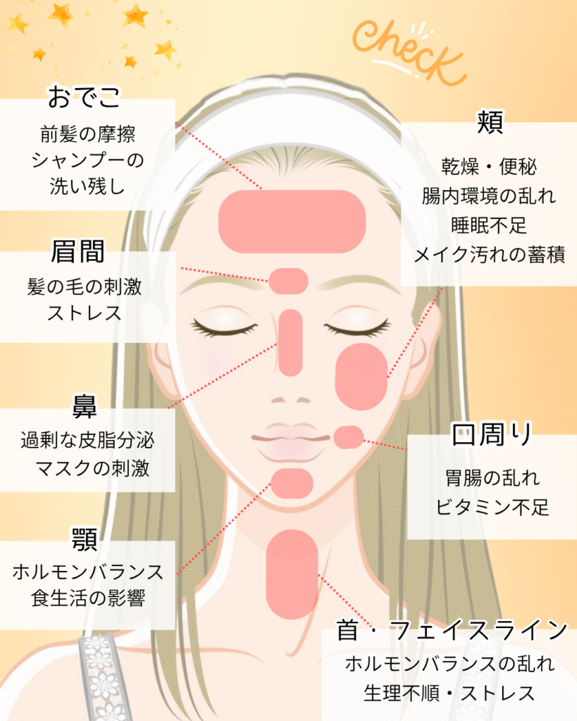 ニキビができる場所と原因は?部位別にチェック